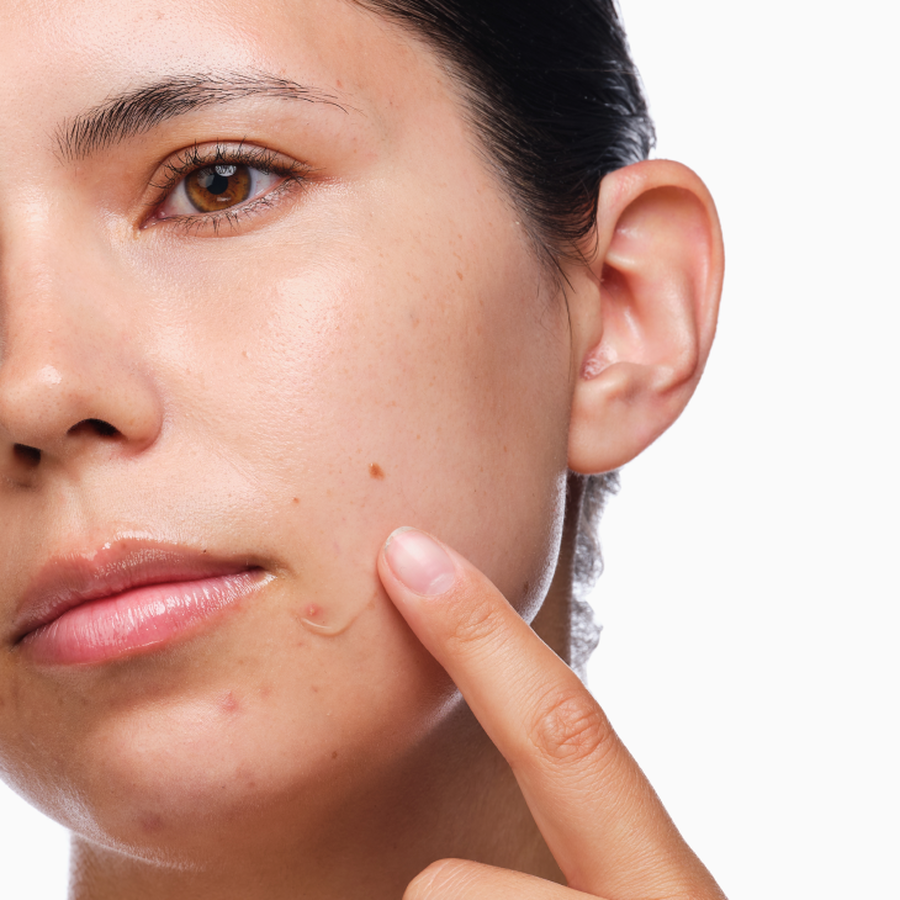 the-acne-set-a9 rdn-the-acne-set-application.png