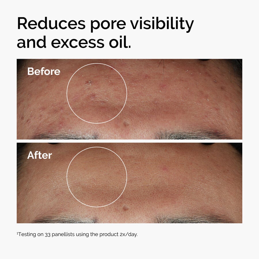 niacinamide-10-zinc-1-t6 ord-niacinamide-zinc-blemish-serum-before-after-pores.jpg
