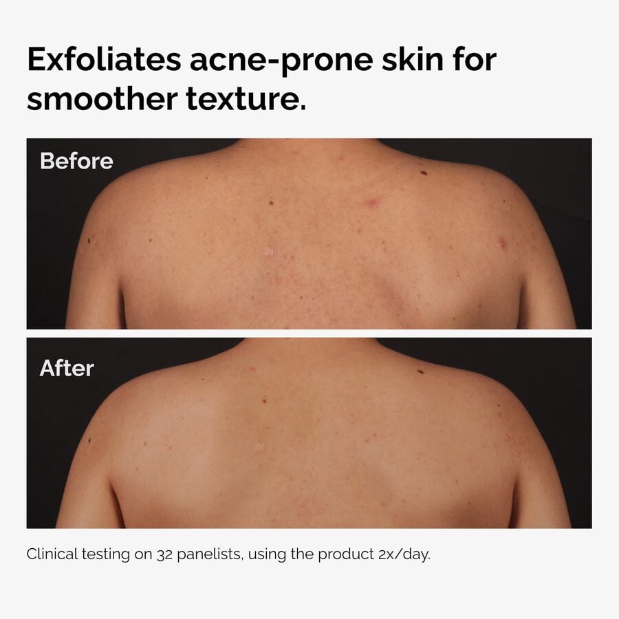 the-body-care-collection-n8 ord-salicylic-acid-body-serum-before-after-graphic-NA.jpg